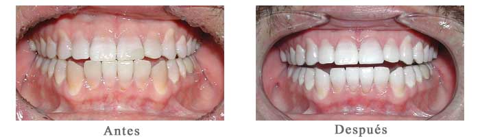 Antes y Despues Blanqueamiento Dental Carlos