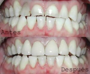 Antes y Después Diseño de Sonrisas caso 6