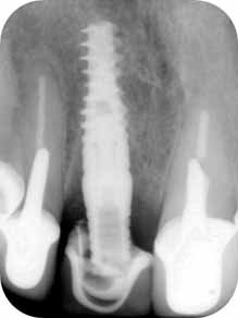 radiografía rellenando los espacios donde estaba el diente