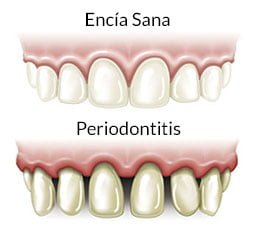 Encías y Periodontitis