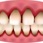 boca gingivitis